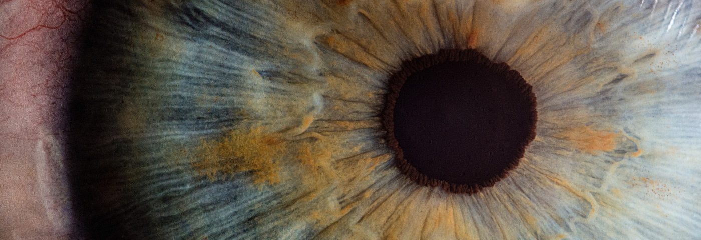 Neurotrophic Keratitis Can Be Side Effect of MP-TCP Surgery for Glaucoma, Case Reports Suggest